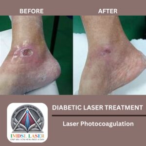 Before and After- Diabetic Laser Treatment